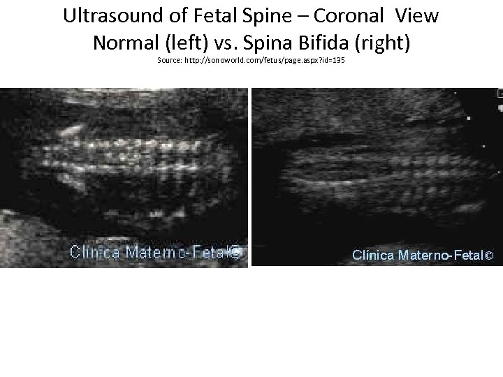 Ultrasound of Fetal Spine – Coronal View Normal (left) vs. Spina Bifida (right) Source: