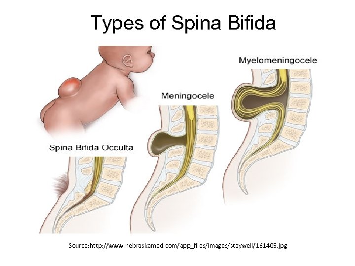 Types of Spina Bifida Source: http: //www. nebraskamed. com/app_files/images/staywell/161405. jpg 