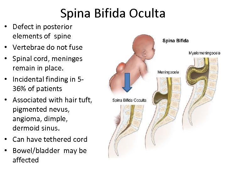 Spina Bifida Oculta • Defect in posterior elements of spine • Vertebrae do not