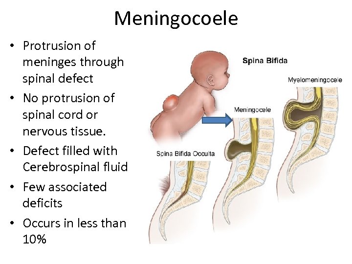 Meningocoele • Protrusion of meninges through spinal defect • No protrusion of spinal cord
