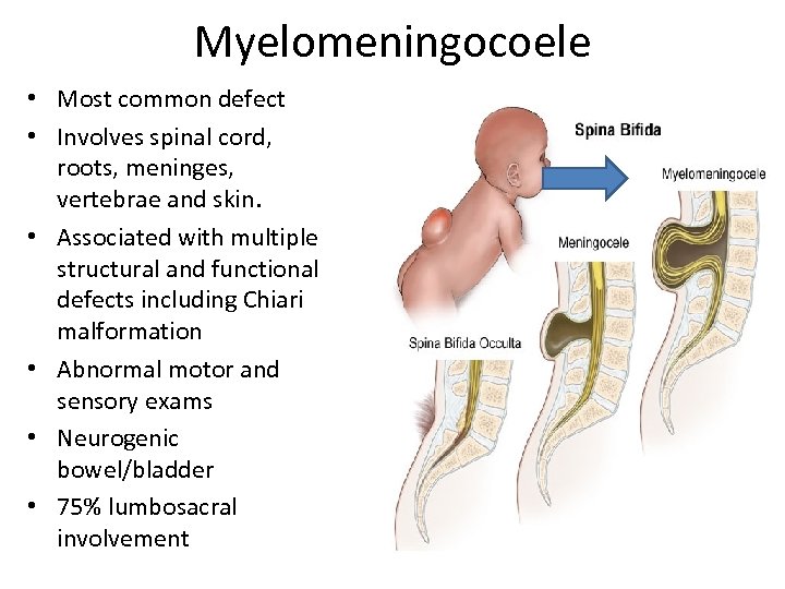 Myelomeningocoele • Most common defect • Involves spinal cord, roots, meninges, vertebrae and skin.