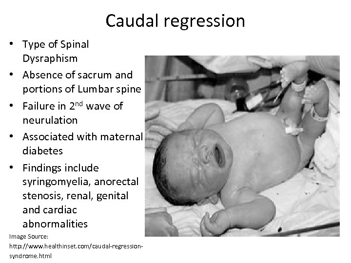 Caudal regression • Type of Spinal Dysraphism • Absence of sacrum and portions of