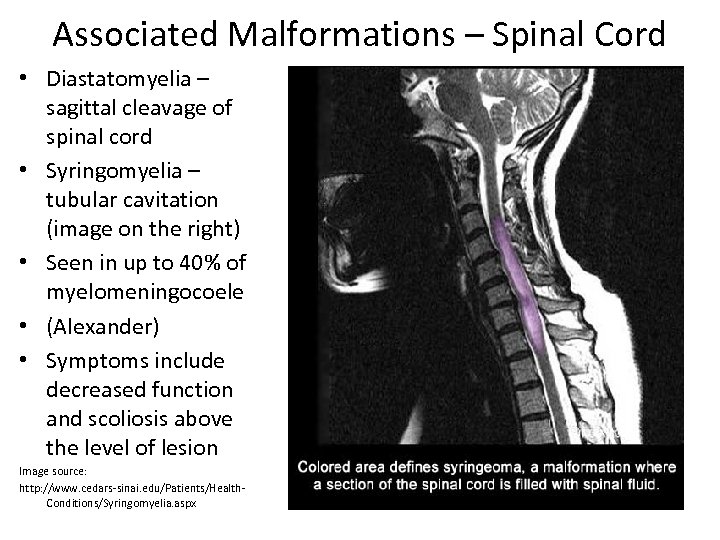 Associated Malformations – Spinal Cord • Diastatomyelia – sagittal cleavage of spinal cord •