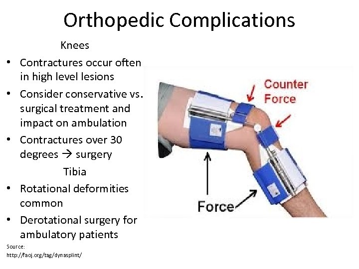 Orthopedic Complications • • • Knees Contractures occur often in high level lesions Consider