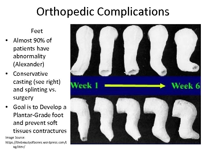 Orthopedic Complications Feet • Almost 90% of patients have abnormality (Alexander) • Conservative casting