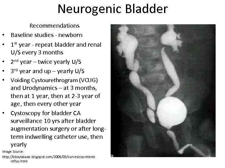 Neurogenic Bladder • • • Recommendations Baseline studies - newborn 1 st year -