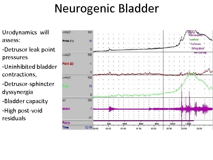 Neurogenic Bladder Urodynamics will assess: -Detrusor leak point pressures -Uninhibited bladder contractions, -Detrusor-sphincter dyssynergia