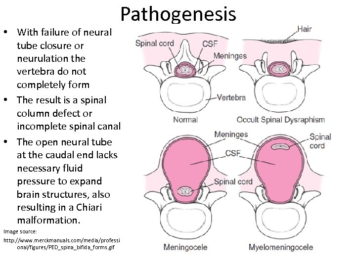 Pathogenesis • With failure of neural tube closure or neurulation the vertebra do not