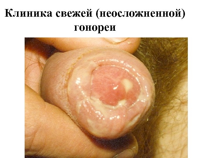 Клиника свежей (неосложненной) гонореи 