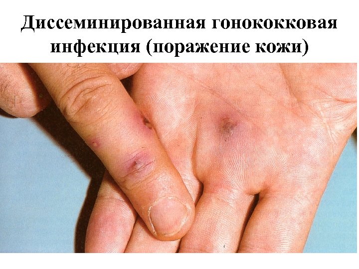 Диссеминированная гонококковая инфекция (поражение кожи) 