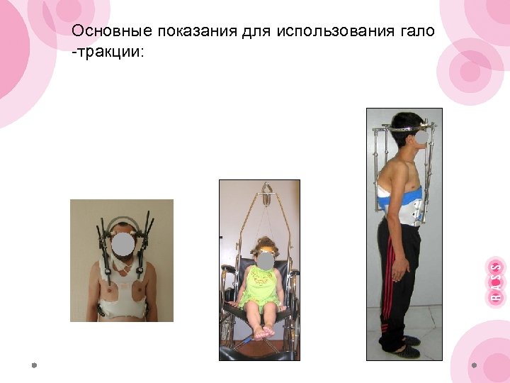 Основные показания для использования гало -тракции: 