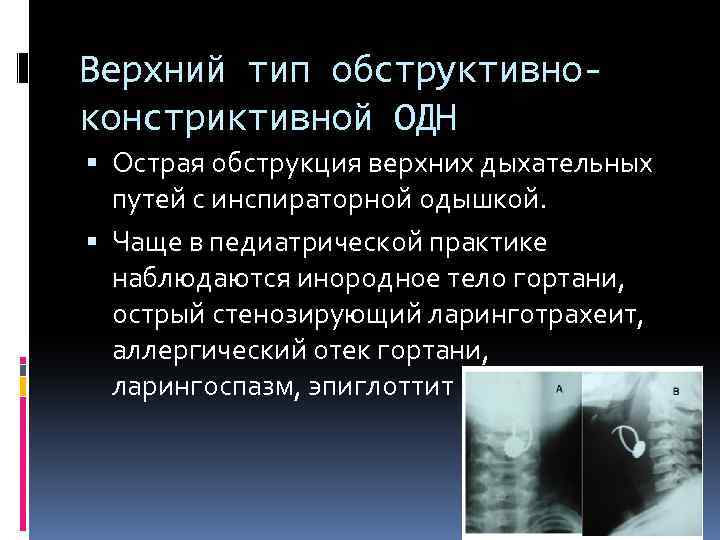 Верхний тип обструктивноконстриктивной ОДН Острая обструкция верхних дыхательных путей с инспираторной одышкой. Чаще в