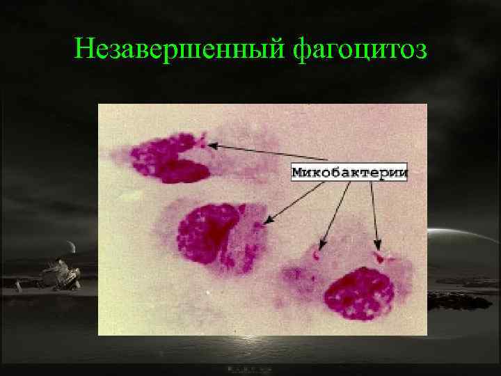 Незавершенный фагоцитоз 