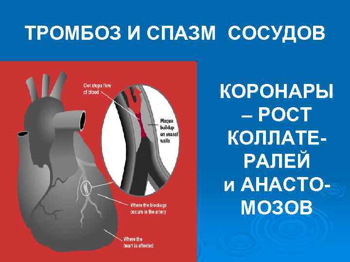 ТРОМБОЗ И СПАЗМ СОСУДОВ КОРОНАРЫ – РОСТ КОЛЛАТЕРАЛЕЙ и АНАСТОМОЗОВ 