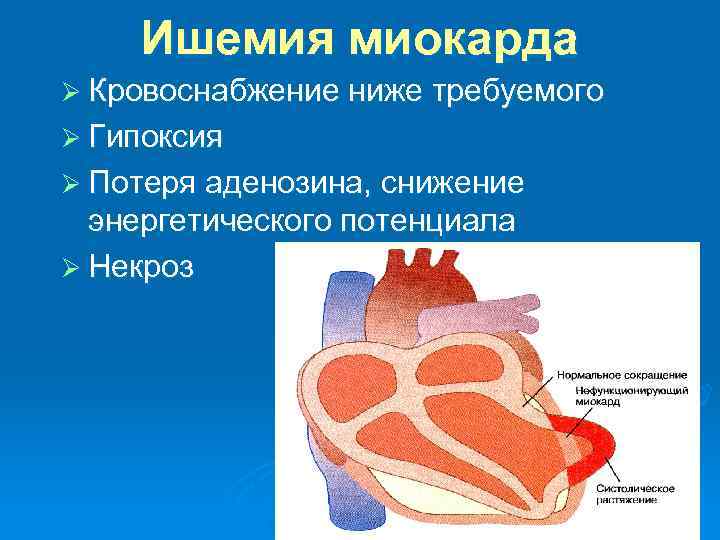 Ишемия миокарда Ø Кровоснабжение ниже требуемого Ø Гипоксия Ø Потеря аденозина, снижение энергетического потенциала