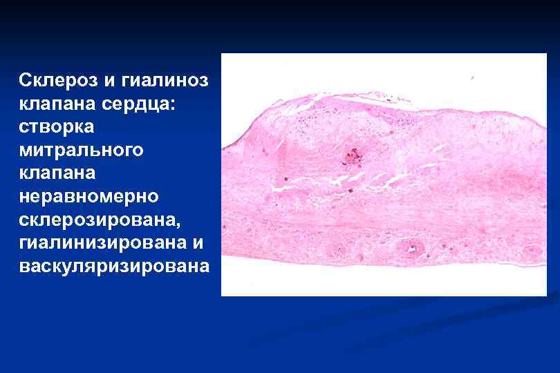 Митральный клапан гистология рисунок