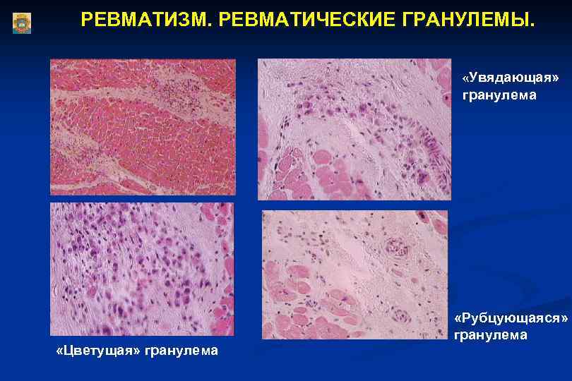 Ревматизм поражение клапана