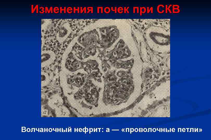 Волчаночный нефрит презентация