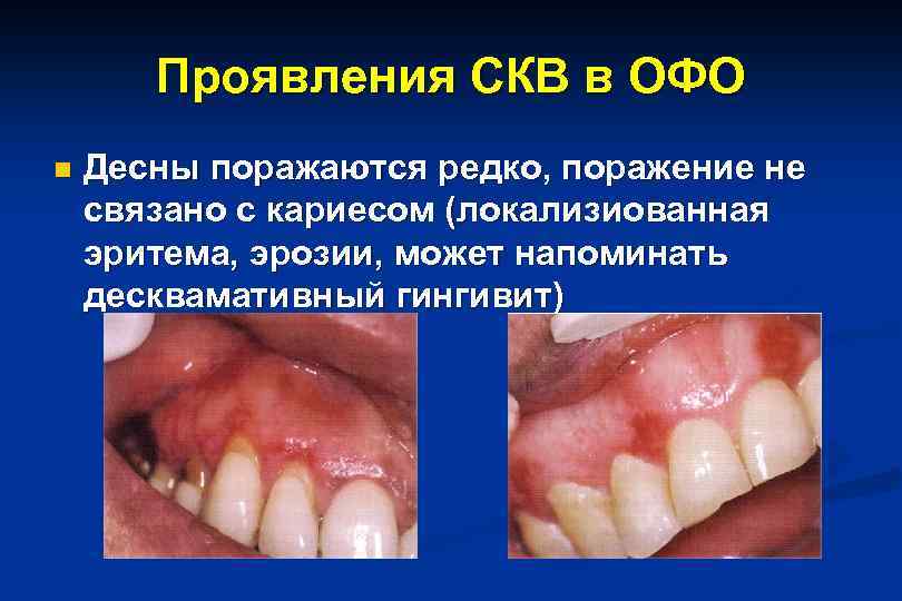 Ревматизм и пороки сердца презентация