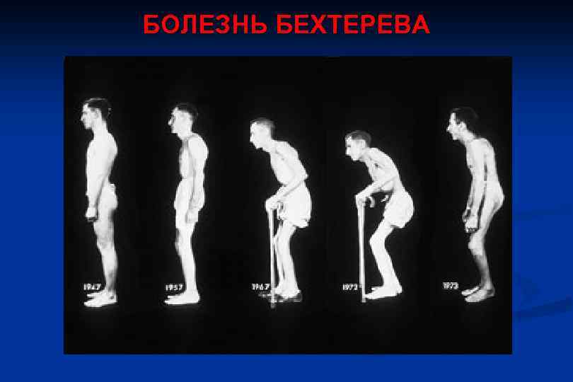 Инверсионный стол при болезни бехтерева