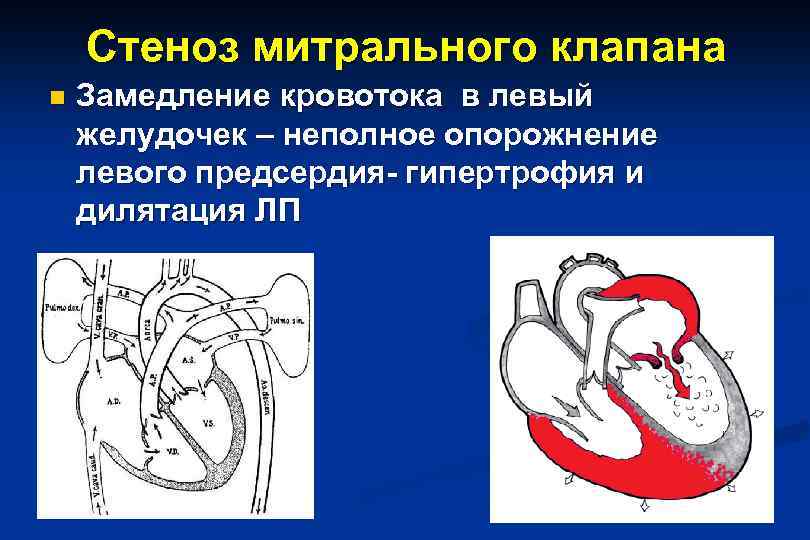 Митральный аортальный стеноз. Порок митрального клапана сердца. Митральный стеноз гемодинамика схема. Митральный стеноз изменения гемодинамики. Стеноз митрального клапана гемодинамика схема.