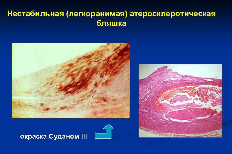 Нестабильная (легкоранимая) атеросклеротическая бляшка окраска Суданом III 