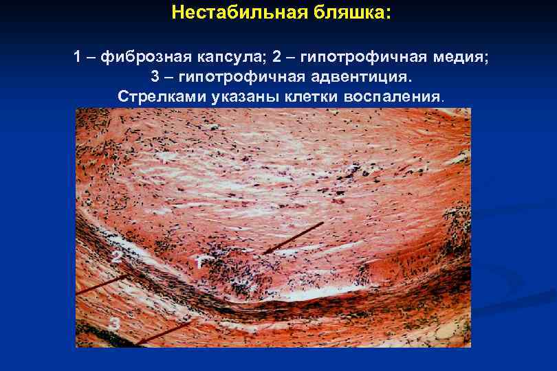 Нестабильная бляшка: 1 – фиброзная капсула; 2 – гипотрофичная медия; 3 – гипотрофичная адвентиция.