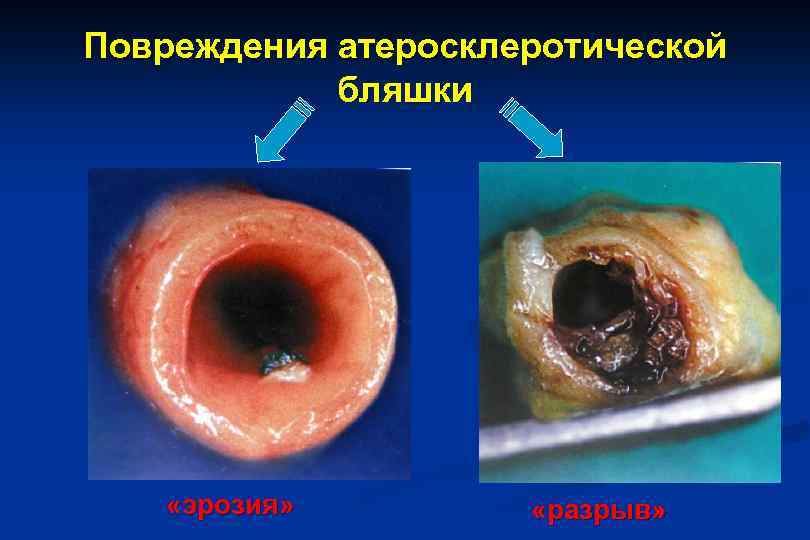 Повреждения атеросклеротической бляшки «эрозия» «разрыв» 