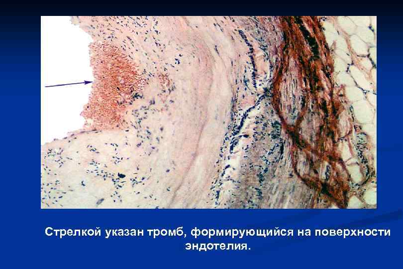 Стрелкой указан тромб, формирующийся на поверхности эндотелия. 