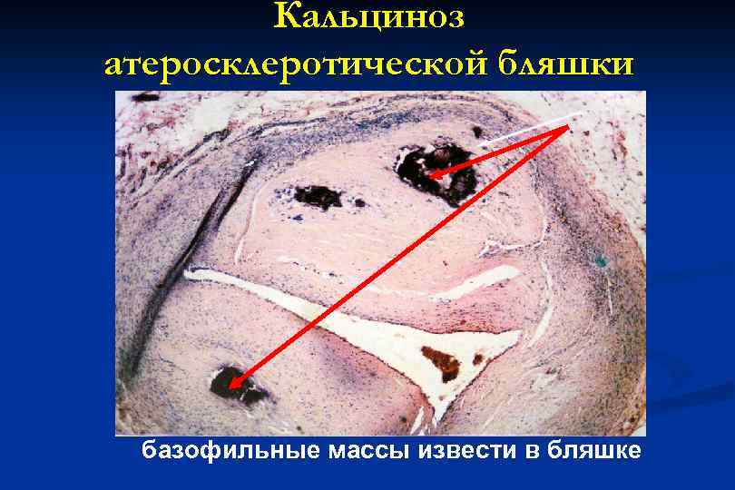 Кальциноз атеросклеротической бляшки базофильные массы извести в бляшке 