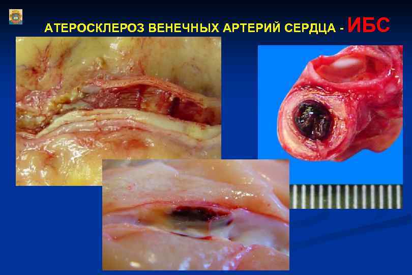 АТЕРОСКЛЕРОЗ ВЕНЕЧНЫХ АРТЕРИЙ СЕРДЦА - ИБС 