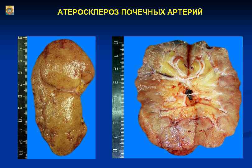 АТЕРОСКЛЕРОЗ ПОЧЕЧНЫХ АРТЕРИЙ 