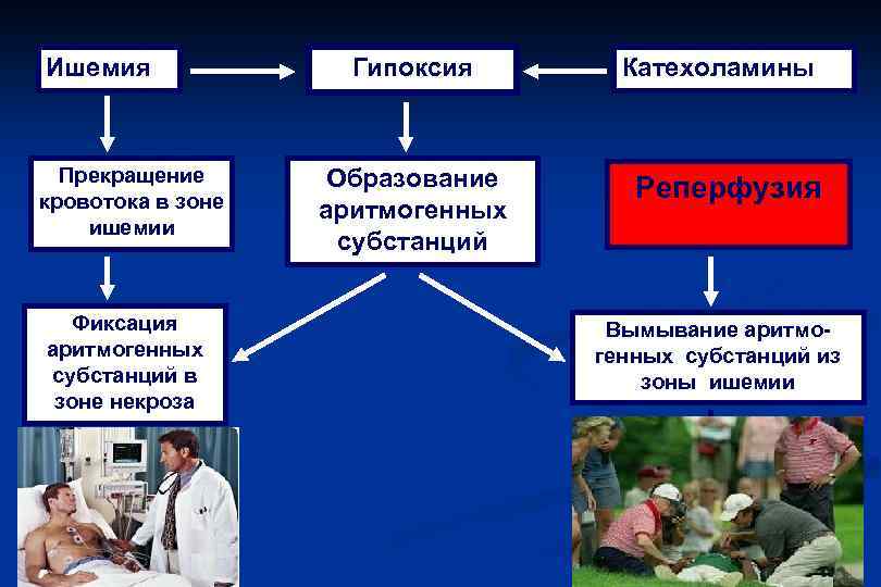 Ишемия Прекращение кровотока в зоне ишемии Гипоксия Образование аритмогенных субстанций Катехоламины Реперфузия Фиксация аритмогенных