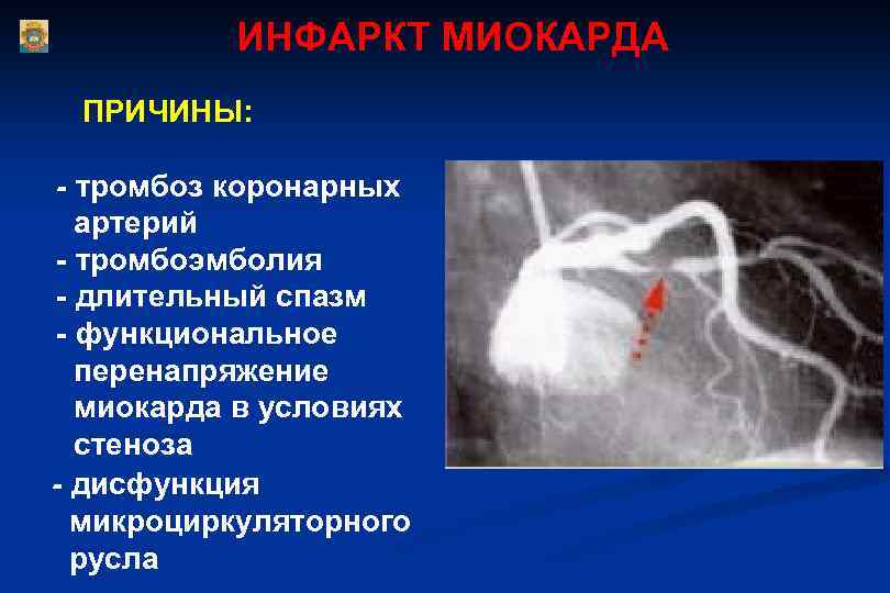 ИНФАРКТ МИОКАРДА ПРИЧИНЫ: - тромбоз коронарных артерий - тромбоэмболия - длительный спазм - функциональное