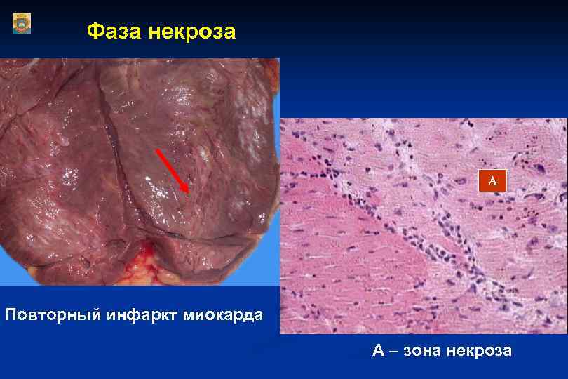 Фаза некроза А Повторный инфаркт миокарда А – зона некроза 