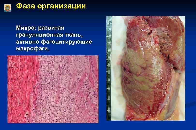 Фаза организации Микро: развитая грануляционная ткань, активно фагоцитирующие макрофаги. 