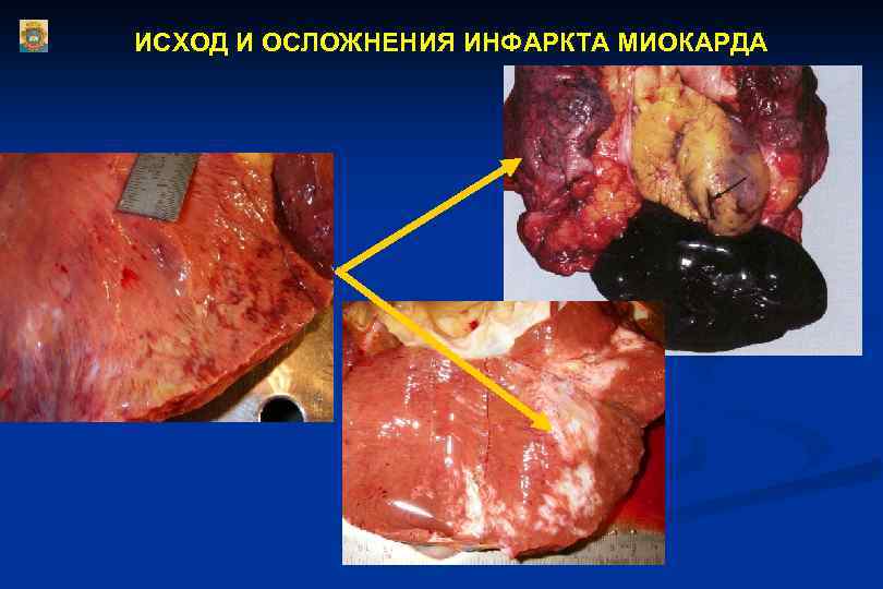 ИСХОД И ОСЛОЖНЕНИЯ ИНФАРКТА МИОКАРДА 