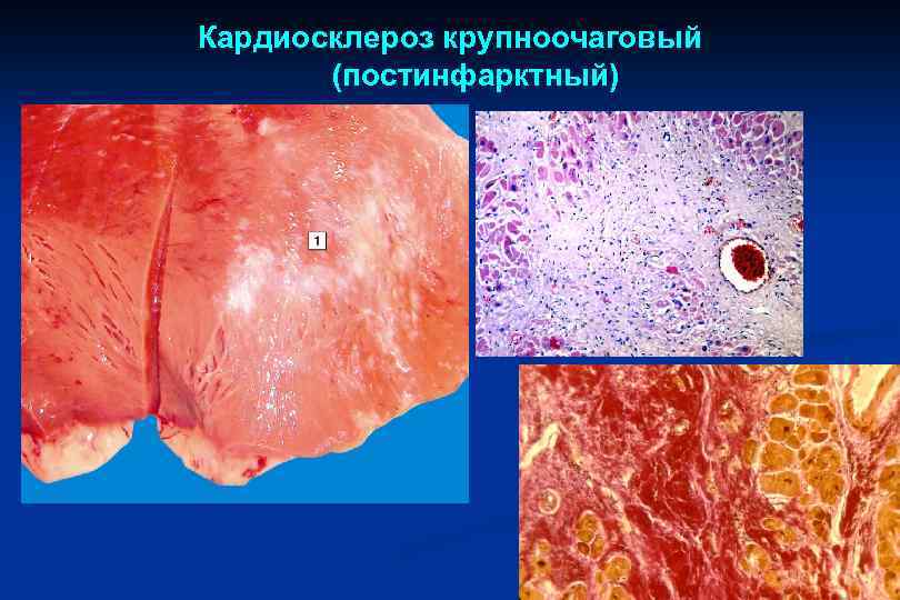 Кардиосклероз крупноочаговый (постинфарктный) 