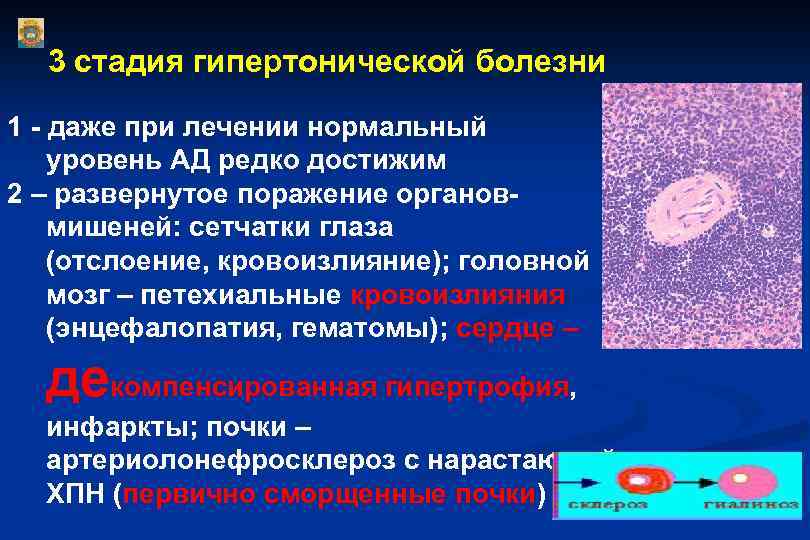 Стадии гипертонии. Стадии при гипертонической болезни. Гипертония 3 степени. Гипертония 3 стадии. Сосудистая стадия гипертонической болезни.