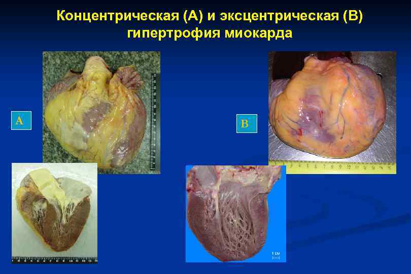 Концентрическая (А) и эксцентрическая (В) гипертрофия миокарда А В 