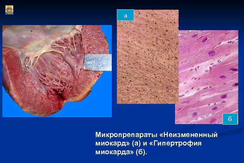 а б Микропрепараты «Неизмененный миокард» (а) и «Гипертрофия миокарда» (б). 