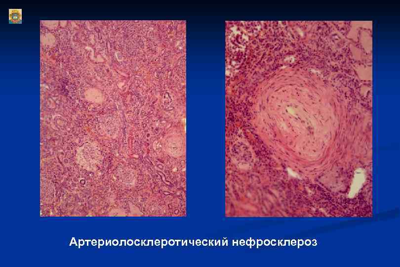 Артериолосклеротический нефросклероз 