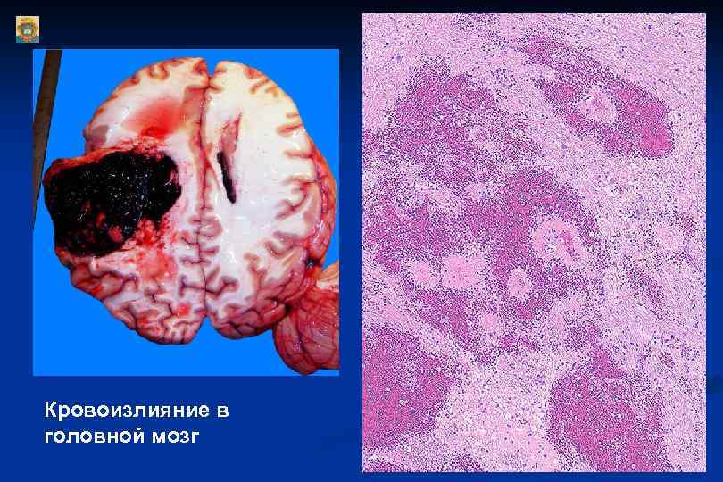 Кровоизлияние в головной мозг 
