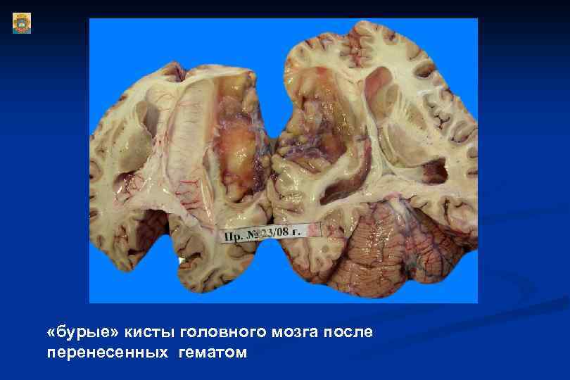  «бурые» кисты головного мозга после перенесенных гематом 