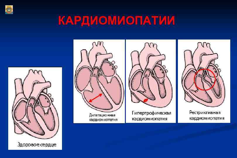 КАРДИОМИОПАТИИ 