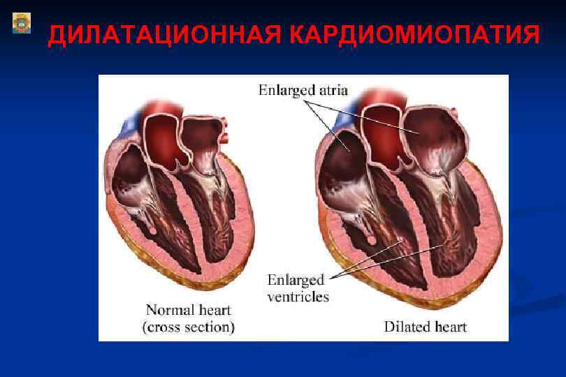 ДИЛАТАЦИОННАЯ КАРДИОМИОПАТИЯ 