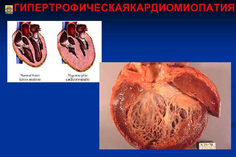 ГИПЕРТРОФИЧЕСКАЯКАРДИОМИОПАТИЯ 