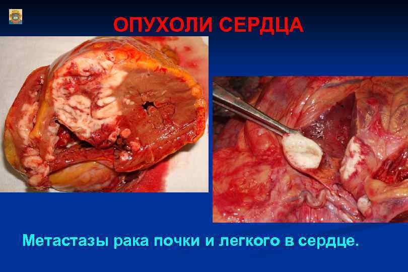 ОПУХОЛИ СЕРДЦА Метастазы рака почки и легкого в сердце. 