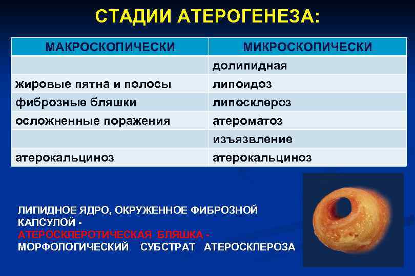 Стадии атеросклероза картинки