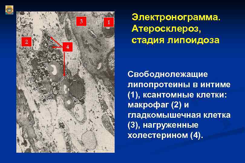 3 2 4 1 Электронограмма. Атеросклероз, стадия липоидоза Свободнолежащие липопротеины в интиме (1), ксантомные